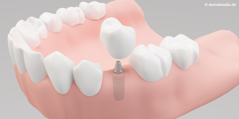 Implantologie : Ein Zahn fehlt  Ein Implantat hat gegenüber einer Brücke den Vorteil, dass Nachbarzähne nicht beschliffen werden müssen.